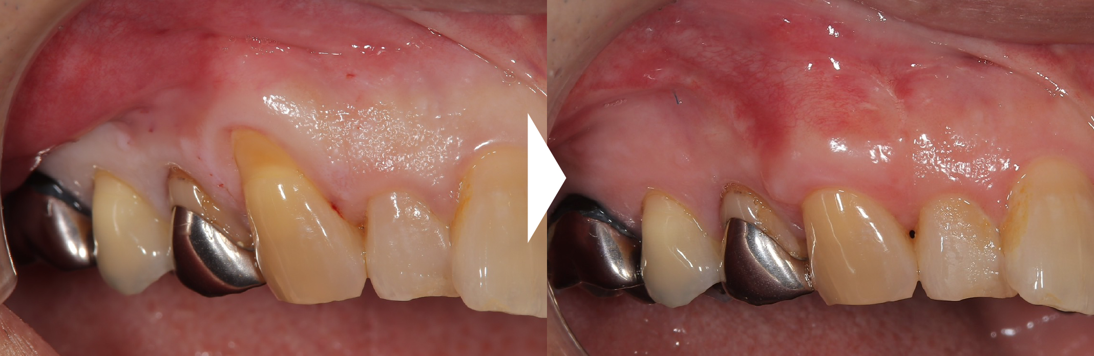 例01.右上の犬歯の歯茎の下がりを改善