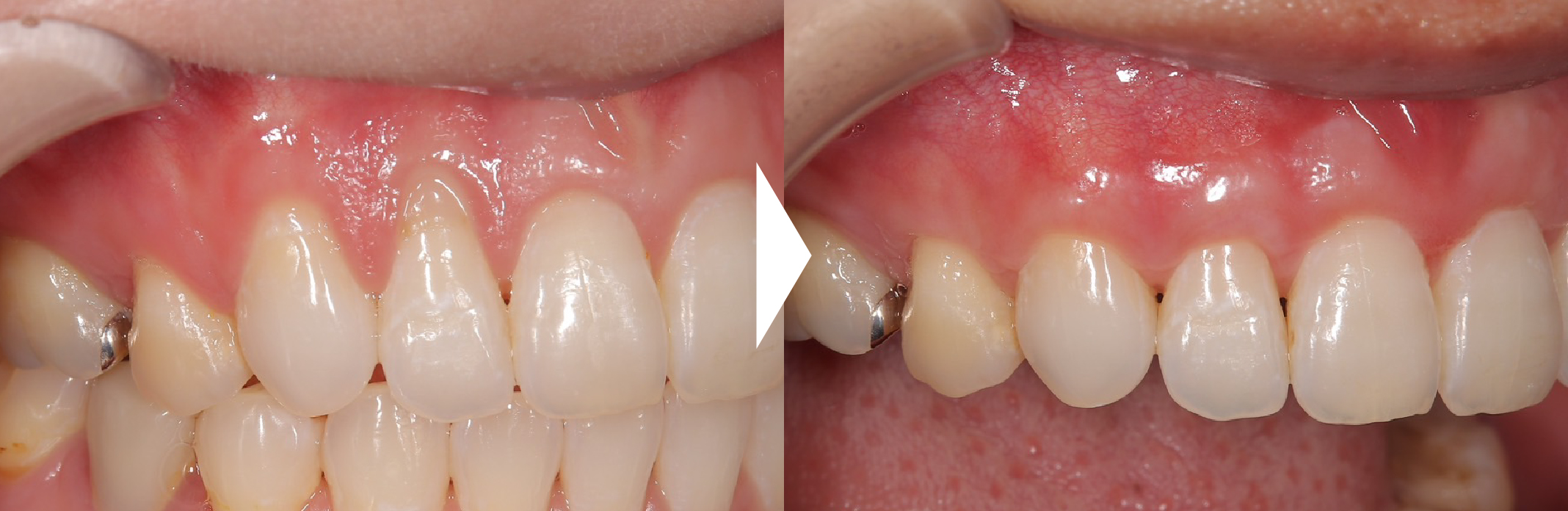 症例02.他院で矯正治療を受けて下がってしまった歯茎の改善