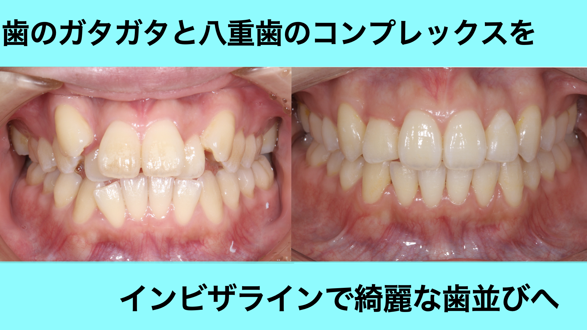 ガタガタの歯並びとコンプレックスだった八重歯を改善した症例（インビザライン）