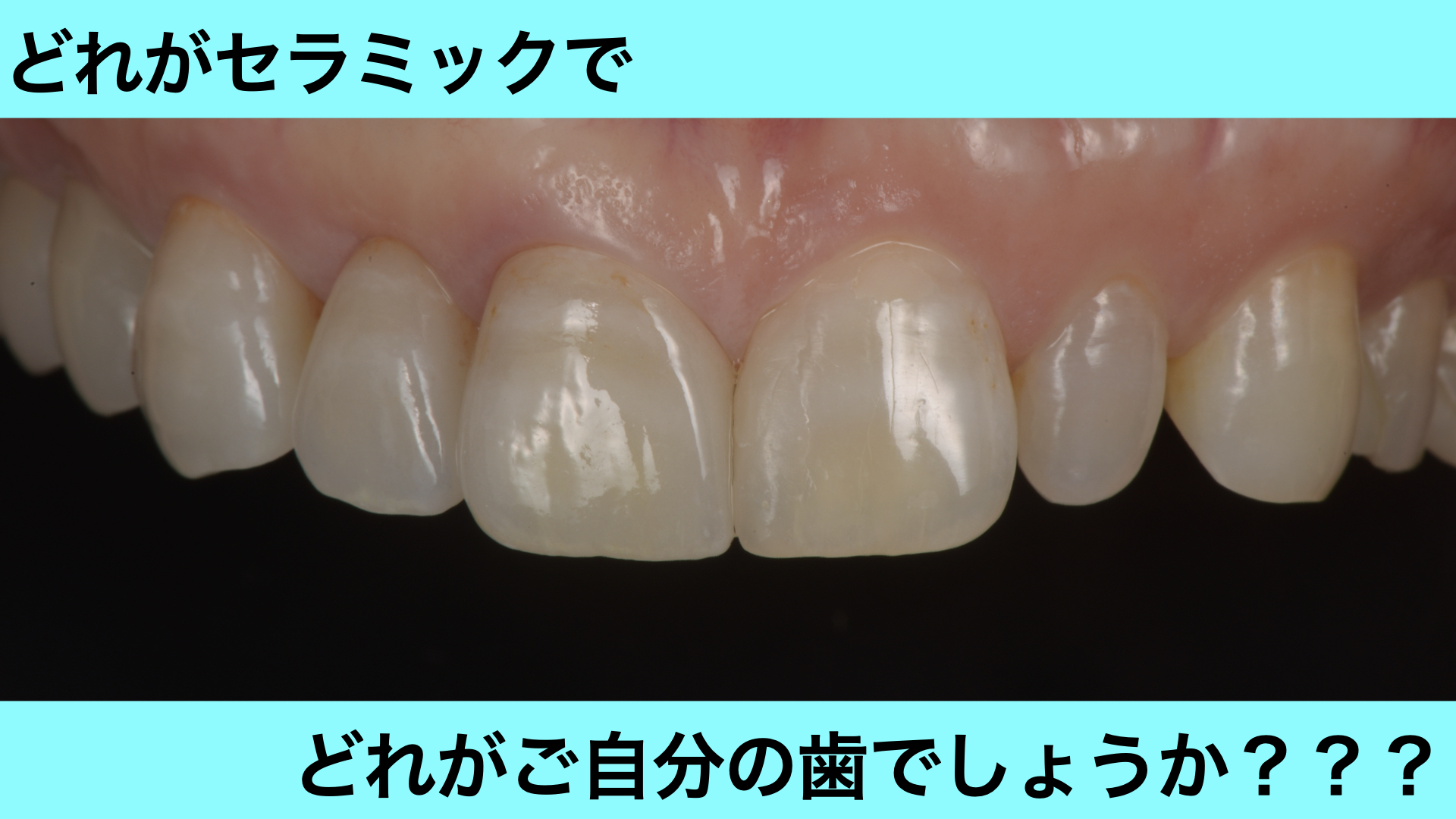 前歯3本に歯茎の再生治療とセラミック治療を行なった症例