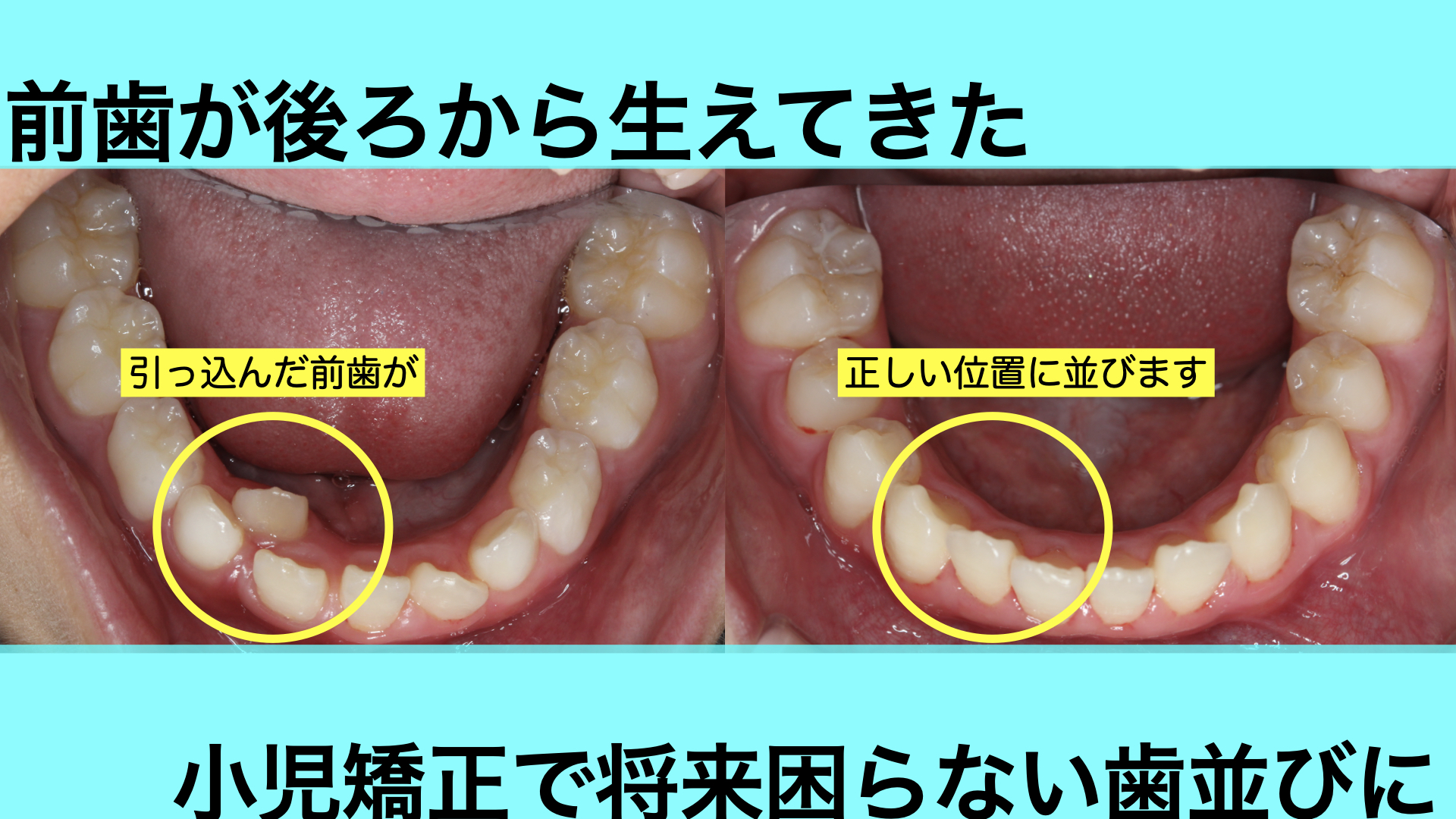 下の前歯が後ろから生えてきた小学生の歯並びを早期治療で改善した症例 - 茨木市の歯医者「てらい歯科クリニック」