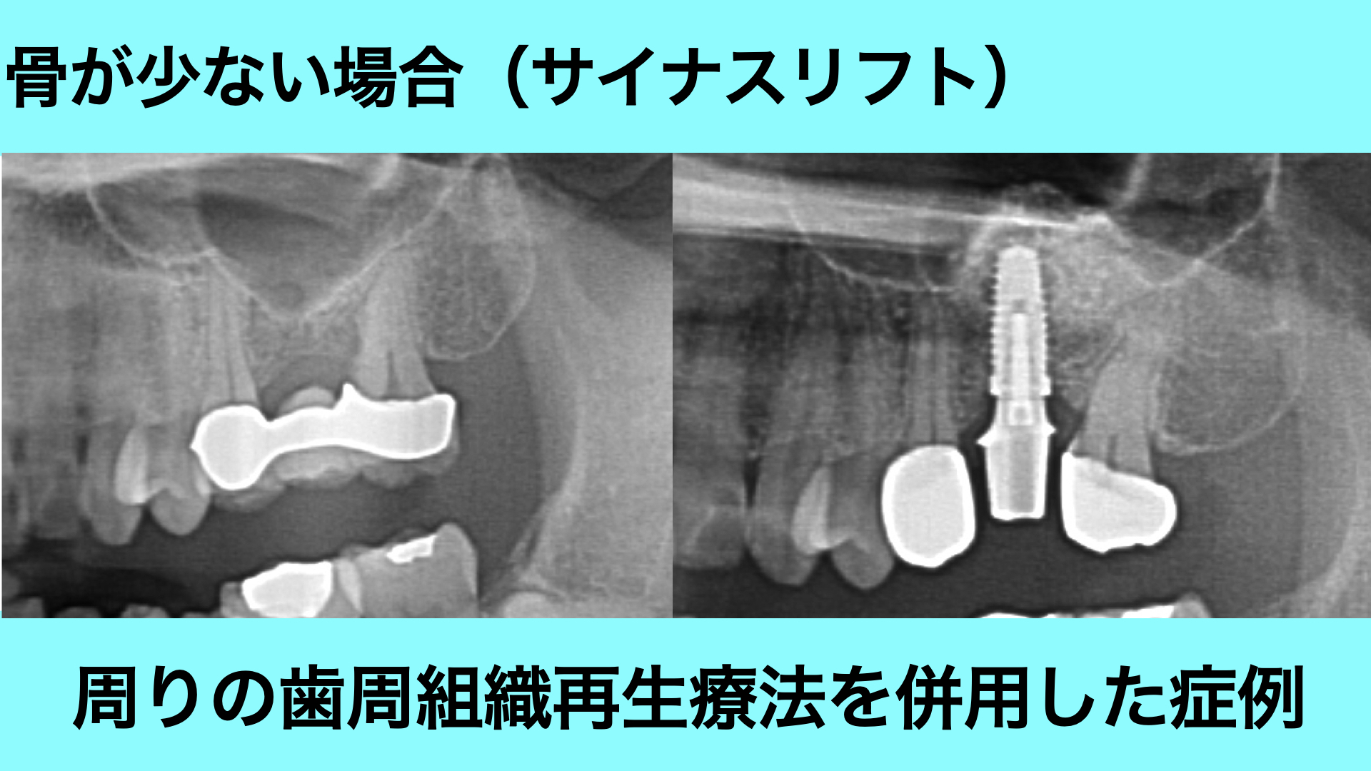 骨が少ない場合の症例（隣の歯の歯周組織再生療法を併用
