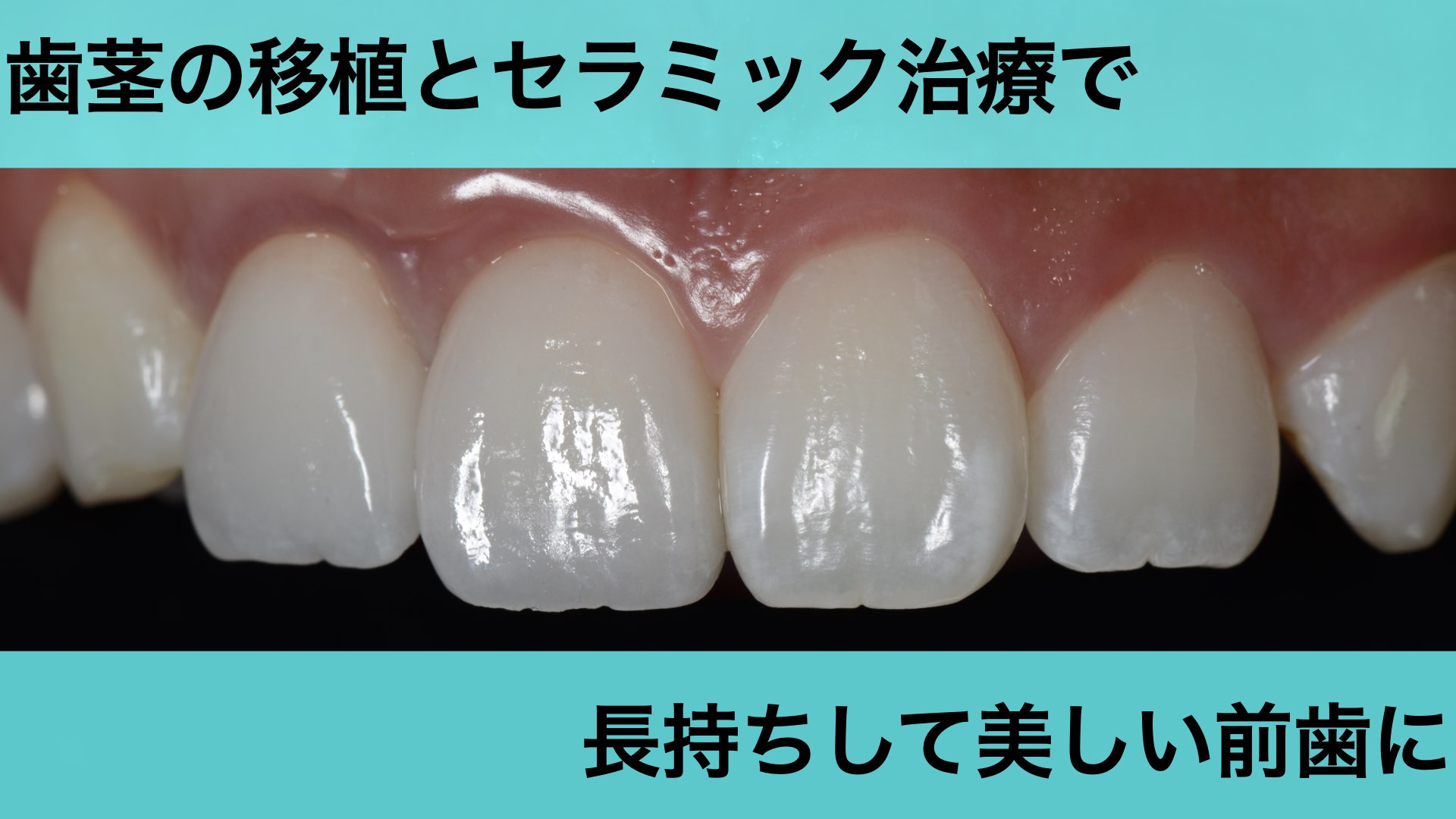 歯茎の変色と見た目を歯茎の再生治療とセラミック治療で改善した症例