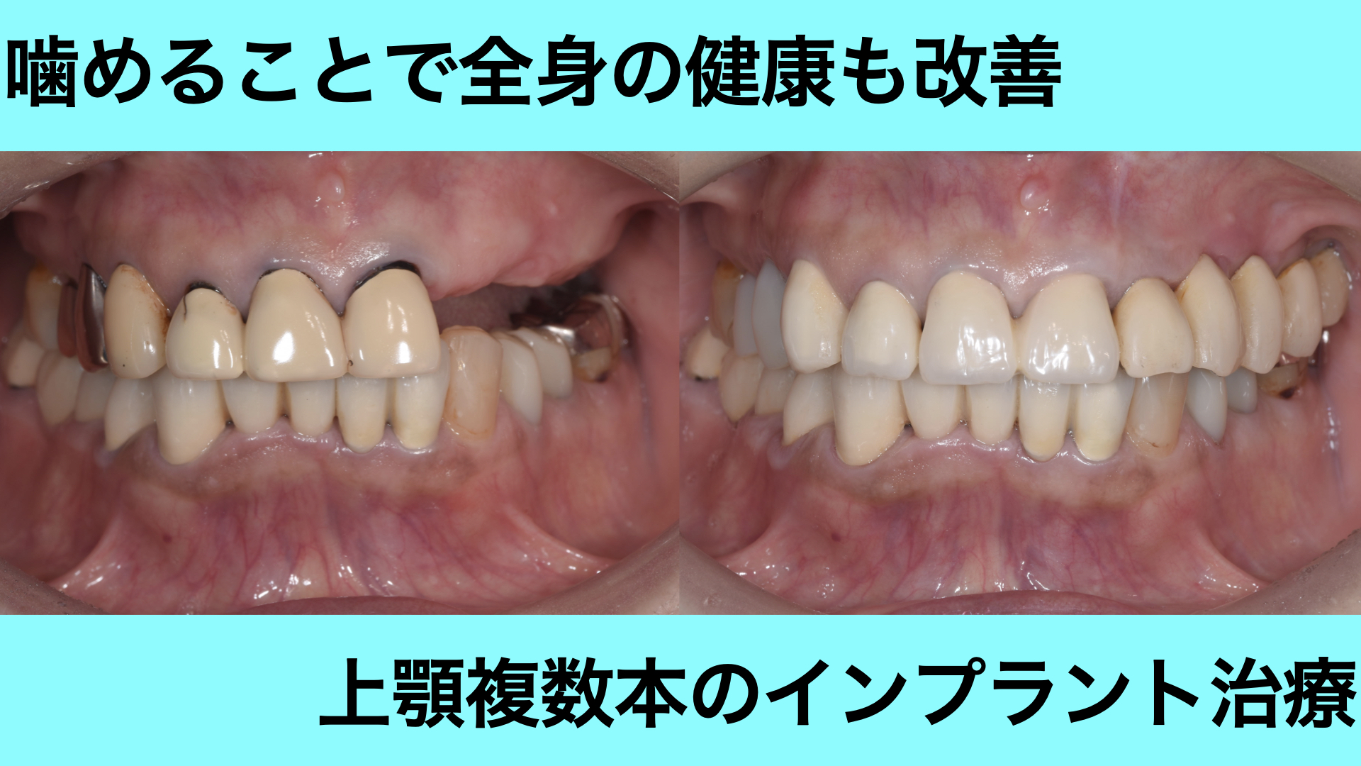 上顎の部分入れ歯が合わずにインプラント治療で改善した症例（70代後半〜食べる喜び〜）