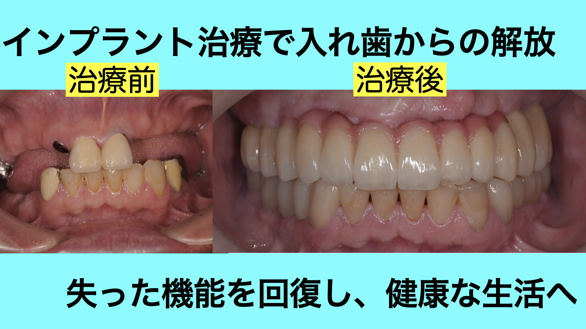 歯がほとんど無く、噛めない状態をインプラント治療で改善した症例