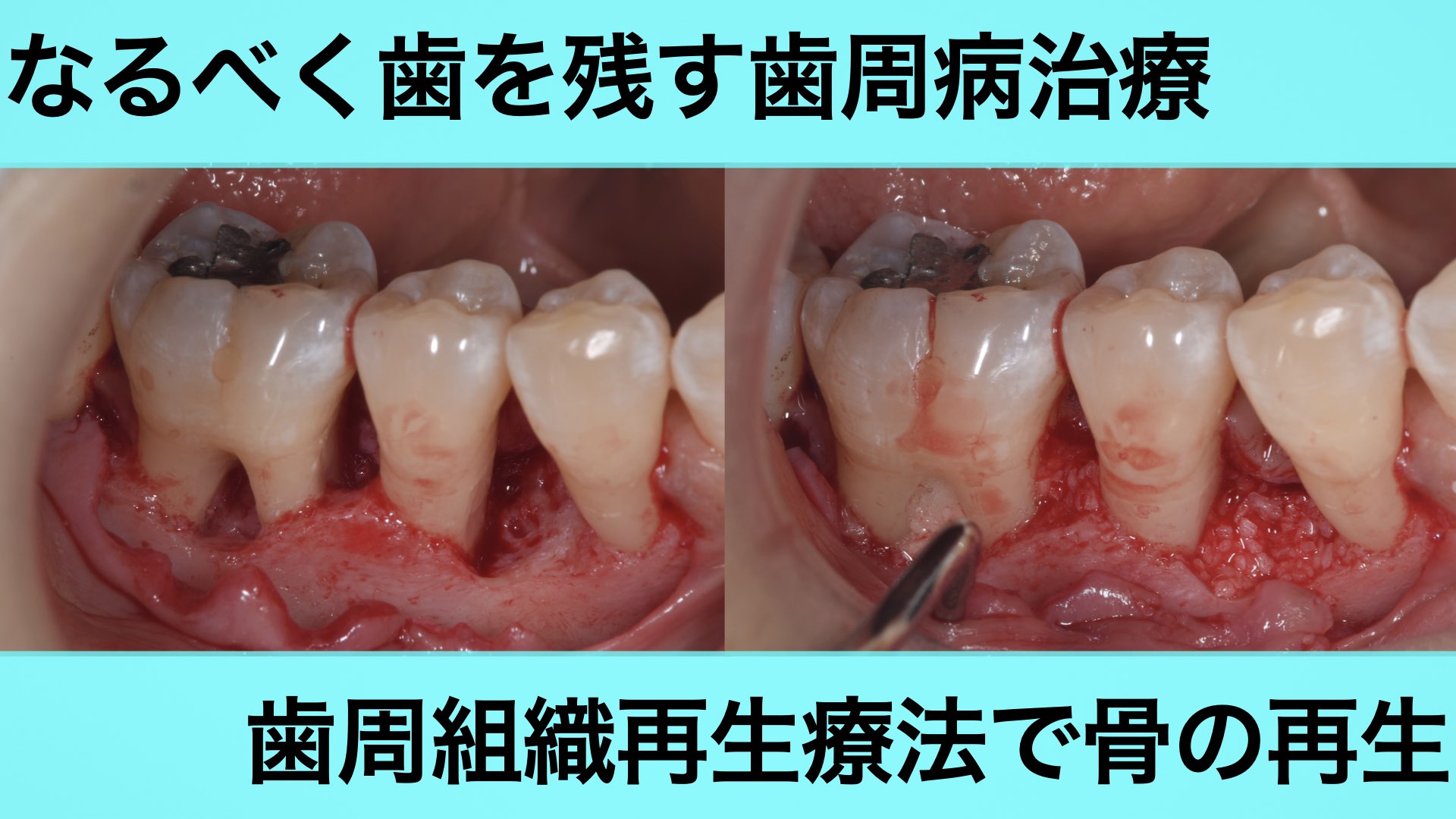 前歯3本に歯茎の再生治療とセラミック治療を行なった症例 - 茨木市の