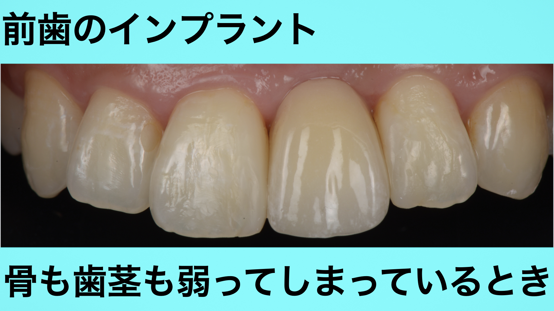 茨木市の歯医者「てらい歯科クリニック」【小児矯正・インプラント】