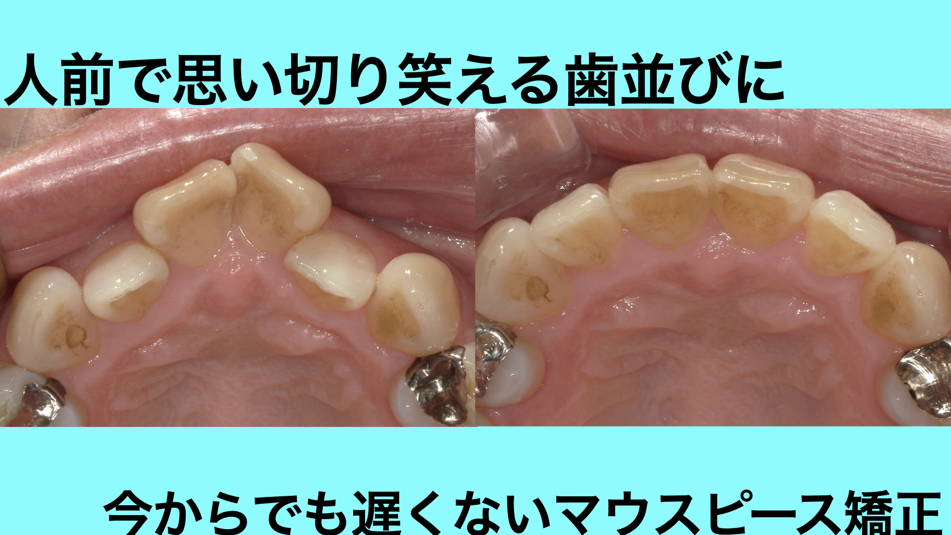 前歯がハの字に並んでおり、ガタつきが気になっている患者様をマウスピース矯正で治療した症例