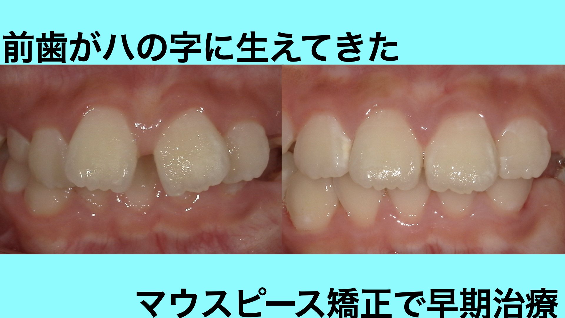 前歯のガタつきと深い噛み合わせをマウスピースで改善した症例