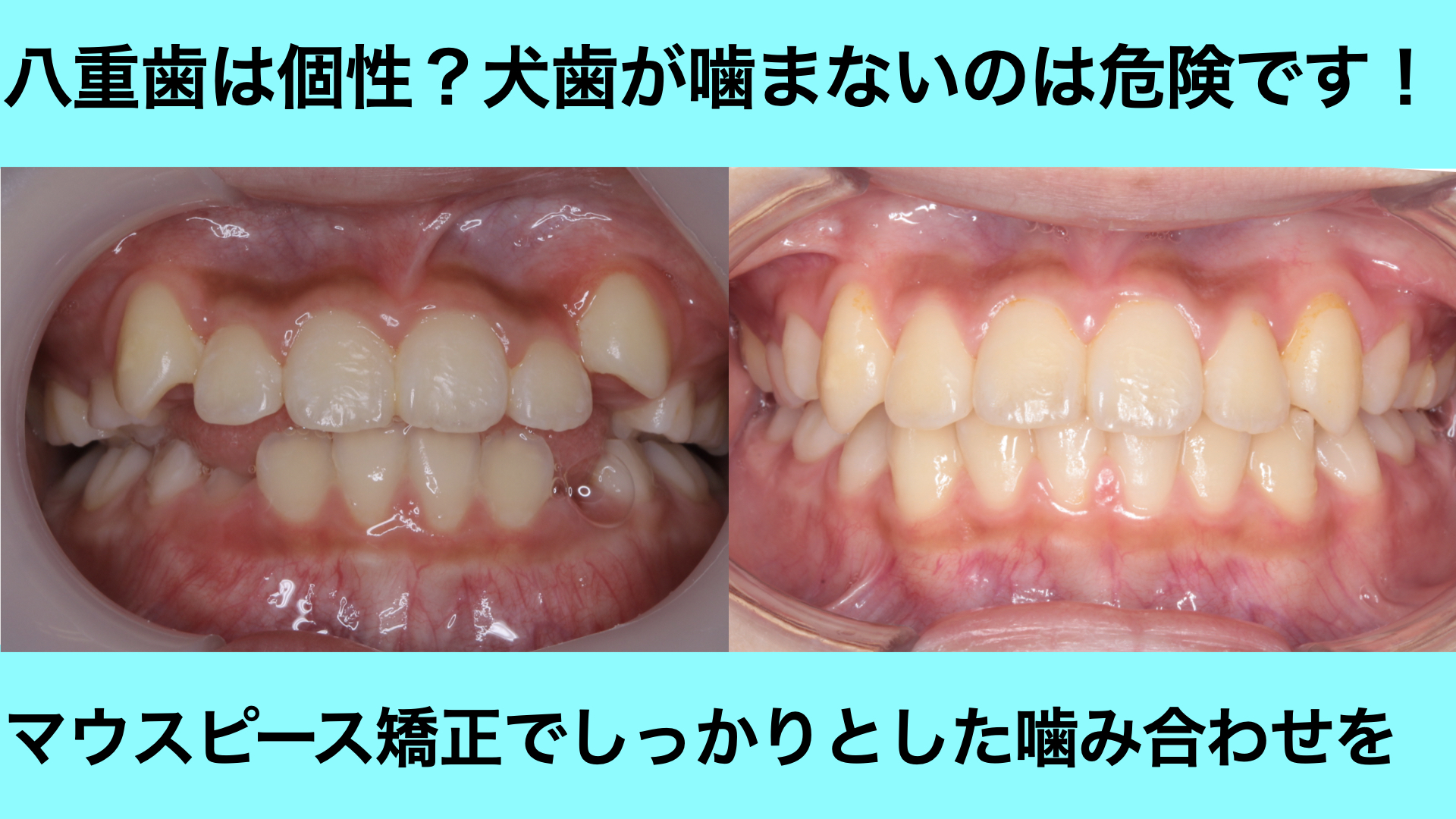 犬歯が唇側に生えてきた歯並び（八重歯）をマウスピース矯正改善した症例
