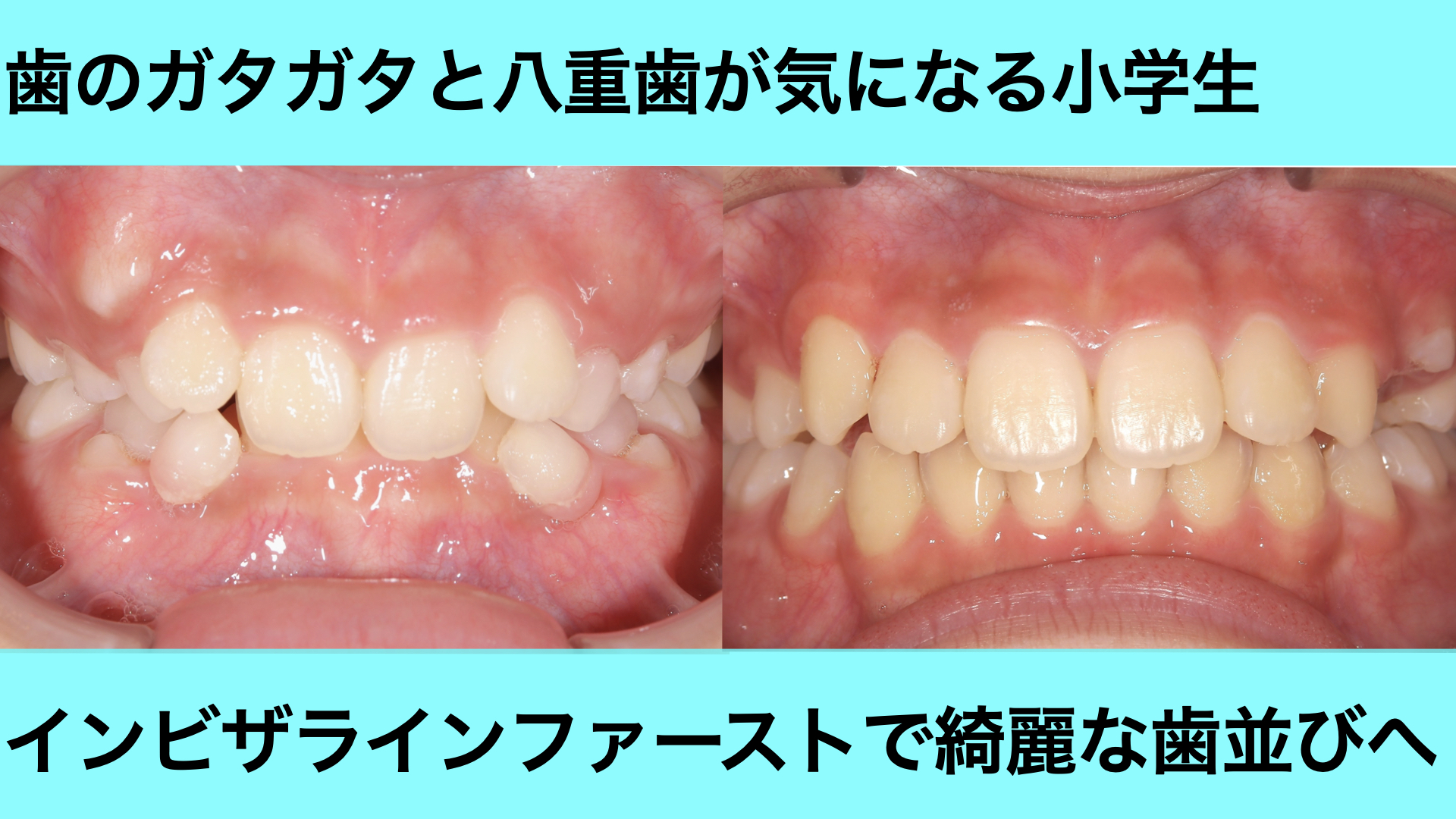 ガタガタの歯並び（小学生）と、八重歯をインビザラインファーストで改善した症例